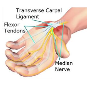 Do you have Carpal Tunnel Syndrome?