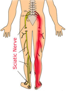 Are you suffering with sciatica?
