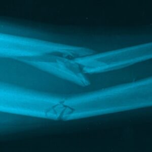 Suffering with a broken or fractured bone?
