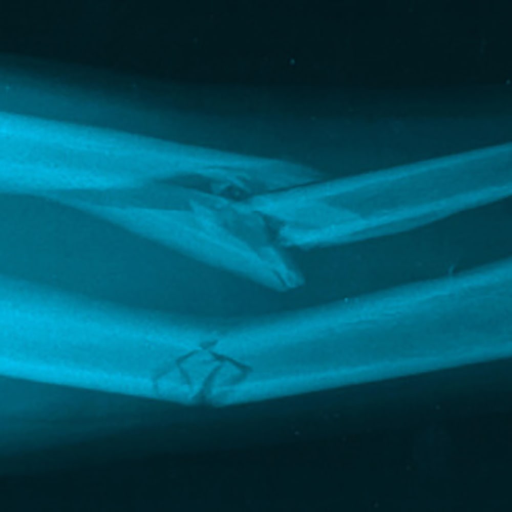 Suffering with a broken or fractured bone?