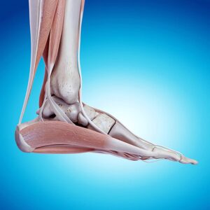 Posterior Tibial Tendonitis
